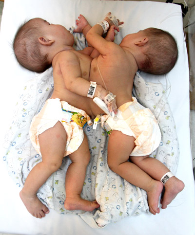 Conjoined twins recovering after 6-hr surgery