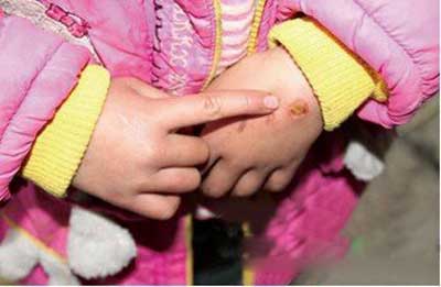 火鉗燙孩子，學(xué)前教育到底怎么了？