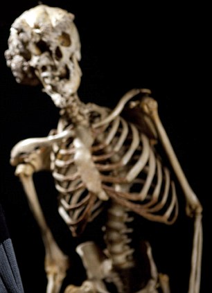 醫(yī)學(xué)“考古”將揭秘英國(guó)大象人怪癥[圖]