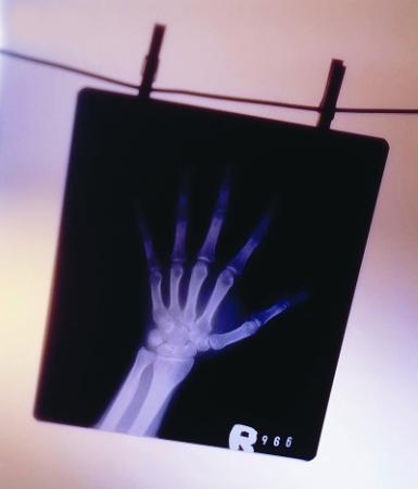 拍X光片時你穿防護服嗎？市民大多不知電離輻射危險