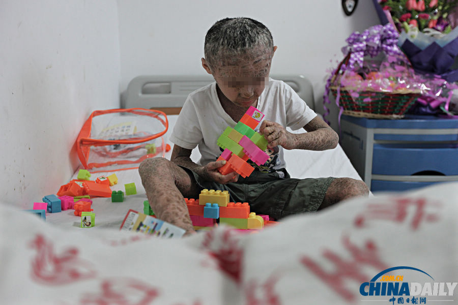 “樹皮娃娃”后續(xù):多位專家為杭杭會診