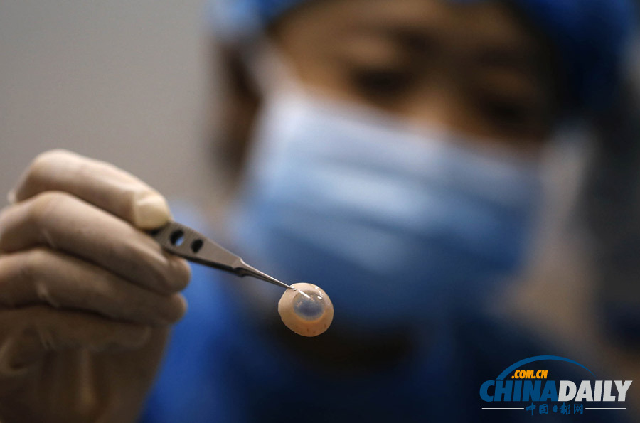 失明患者獲異國(guó)角膜“點(diǎn)亮”右眼 捐贈(zèng)者車(chē)禍過(guò)世