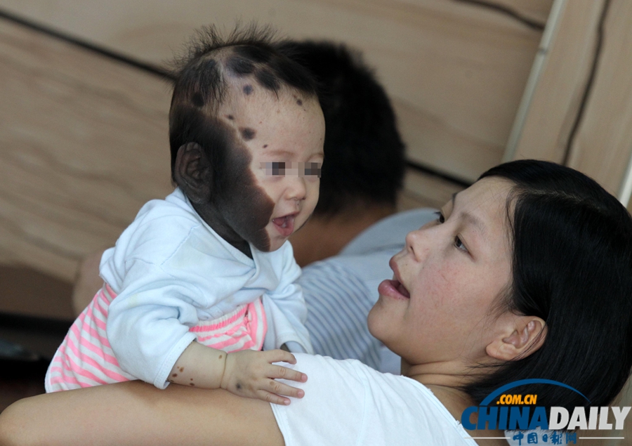 “斑點(diǎn)寶寶”赴上海求醫(yī)