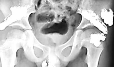 昆明疑被灌汞男童今天做手術(shù) 警方已立案調(diào)查