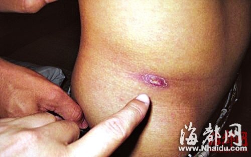 閩現(xiàn)多起恙蟲病例 廈門一男子險喪命