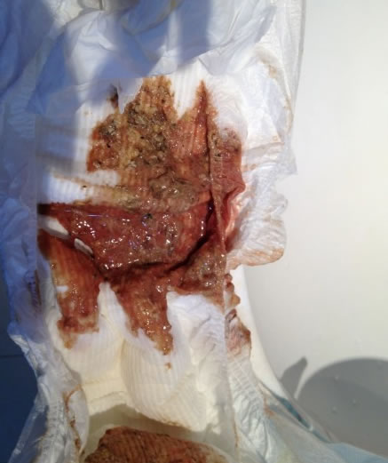 北京嬰兒喝惠氏奶粉拉血便 三個(gè)小時(shí)吐四次