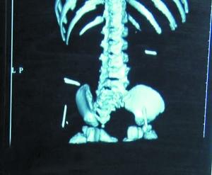 11個月女嬰體內(nèi)有6根針 知情人透露:或因家庭矛盾