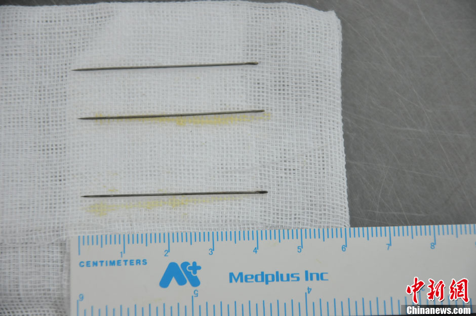 黑龍江被“縫衣針”扎傷女嬰手術(shù)成功