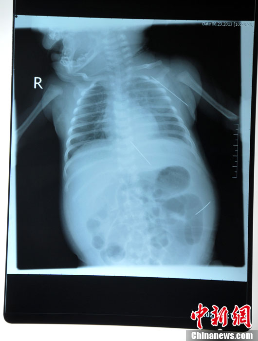 黑龍江被“縫衣針”扎傷女嬰手術成功