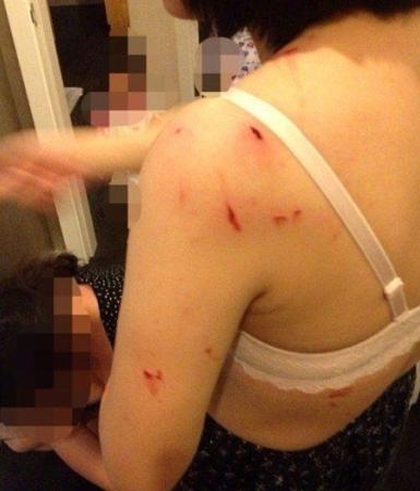 女子洗澡時(shí)浴室玻璃自爆 全身20多處被割傷(圖)