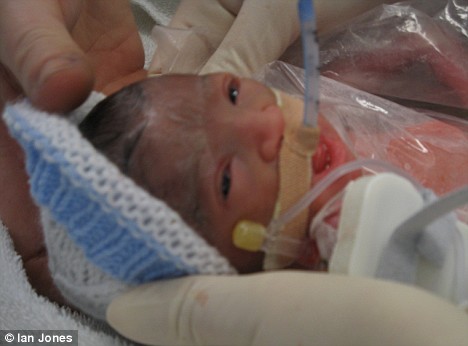 腦瘤引發(fā)腦溢血 英國女子死后兩天產(chǎn)下健康女嬰