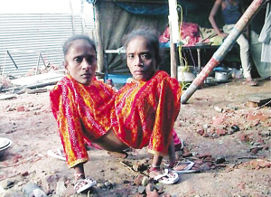 印度“蜘蛛女”拒分體 同嫁一個(gè)丈夫