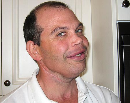 英國男子接受“變臉”手術(shù) 肋骨臀骨植入面部