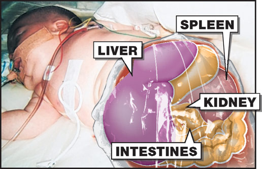 英男嬰患罕見(jiàn)癌癥 需“掏空內(nèi)臟”治癌