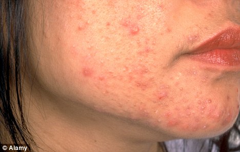 科學(xué)家研發(fā)新型青春痘疫苗 不留疤痕最早5年面世