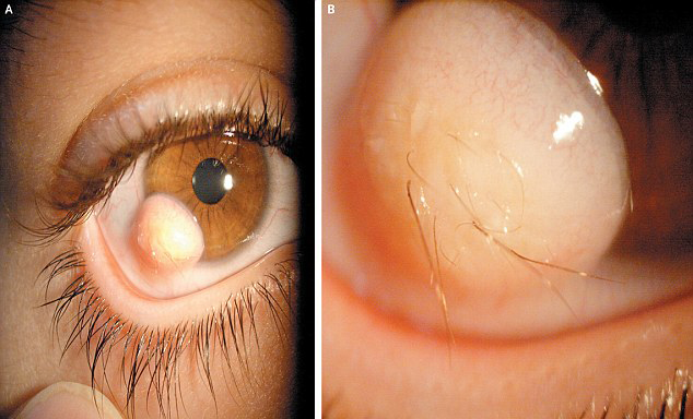眼球上長毛發(fā)！伊朗小伙眼部奇異囊腫恐怖駭人