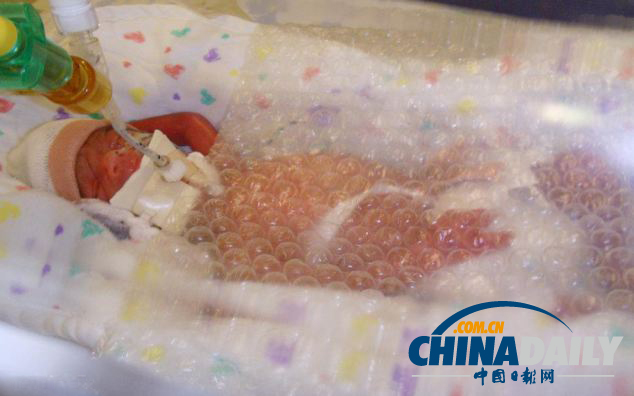 英出生不足1斤女嬰裹氣泡布存活