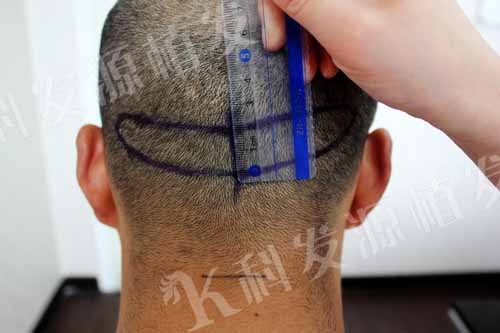 張青松:我之最 一次植發(fā)三種技術(shù)