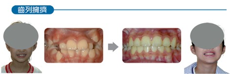 口腔專家何啟洸:牙齒矯正 越早越好