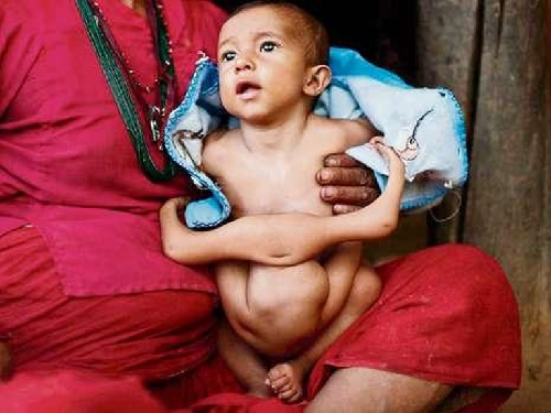 尼泊爾男嬰生來(lái)4條胳膊4條腿 形似象鼻神引人膜拜