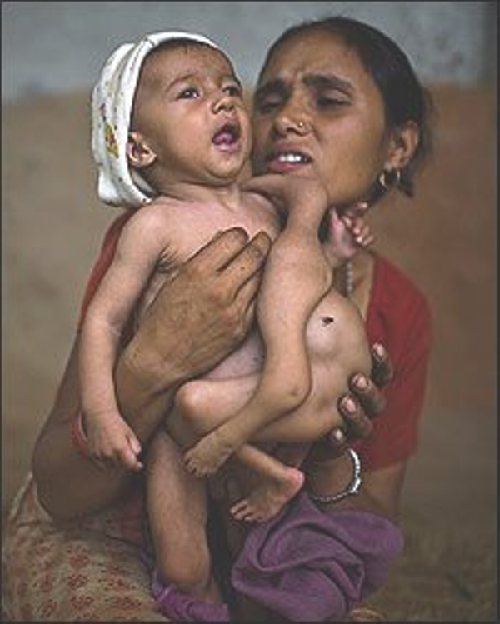 尼泊爾男嬰生來(lái)4條胳膊4條腿 形似象鼻神引人膜拜