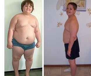 減肥手術(shù)最小患者：美國10歲男孩“切胃”救命