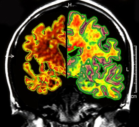 美進(jìn)行首例大腦“起搏器”移植手術(shù) 有望治療老年癡呆癥