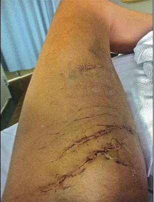 左腿被咬得死死的!23歲美女鱷魚嘴大逃生(圖片新聞)