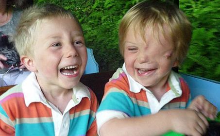 英國男童天生“半臉” 同胞兄弟情令人動(dòng)容