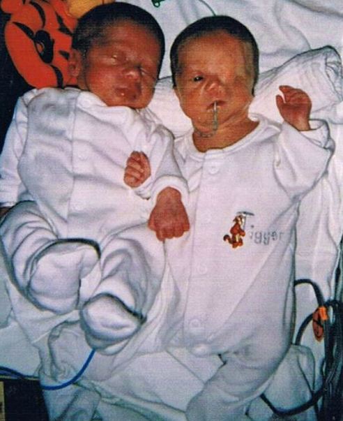 英國男童天生“半臉” 同胞兄弟情令人動(dòng)容