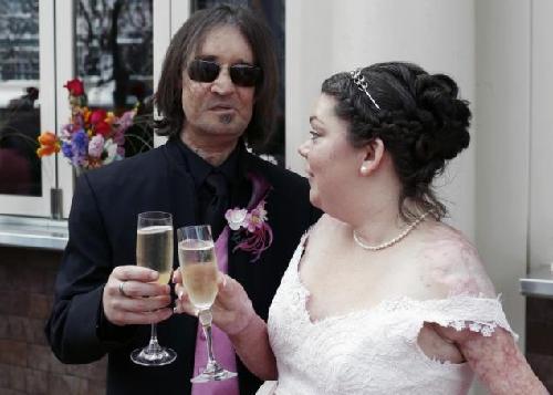 美首位“換臉人”與另一位燒傷患者喜結(jié)連理