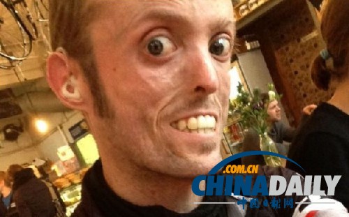 基因組測(cè)序技術(shù)幫忙破解英國(guó)殘疾賽車手暴瘦之謎