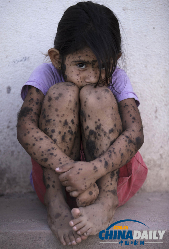 農(nóng)藥遺毒深重 農(nóng)業(yè)大國(guó)阿根廷付出慘痛代價(jià)