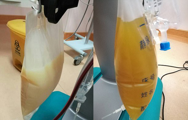 中山男子腹痛緊急送醫(yī)搶救，檢出“牛奶血”！