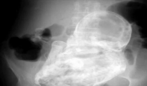 奇聞:82歲老太懷孕40年